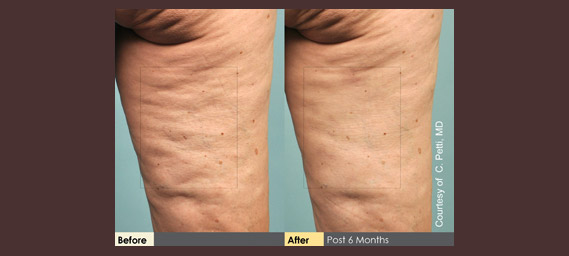 Cellulaze Before & After Photos