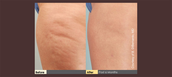 Cellulaze Before & After Photos