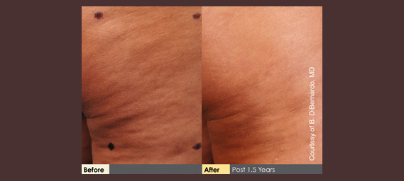 Cellulaze Before & After Photos