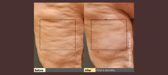 Cellulaze Before & After Photos