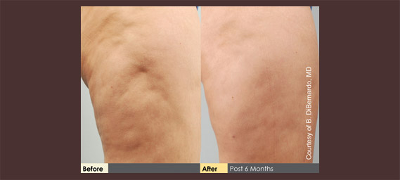 Cellulaze Before & After Photos