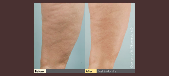 Cellulaze Before & After Photos