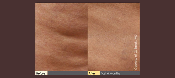 Cellulaze Before & After Photos