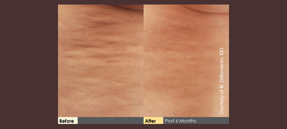 Cellulaze Before & After Photos