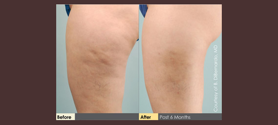 Cellulaze Before & After Photos