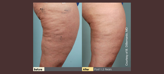 Cellulaze Before & After Photos