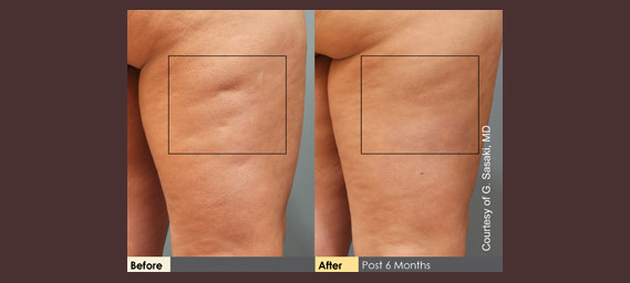 Cellulaze Before & After Photos